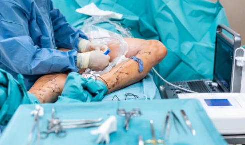 varicose veins surgery